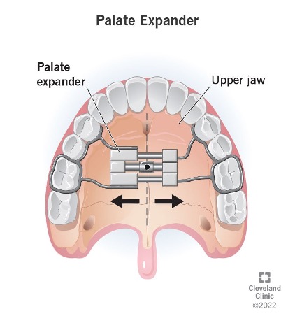Palate Expander Example